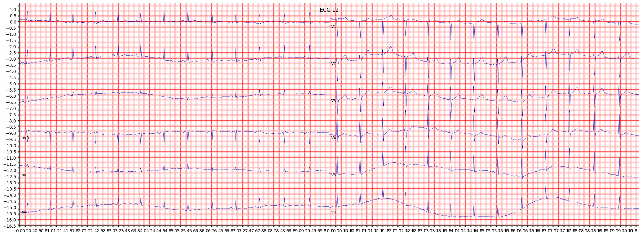 ECG example image