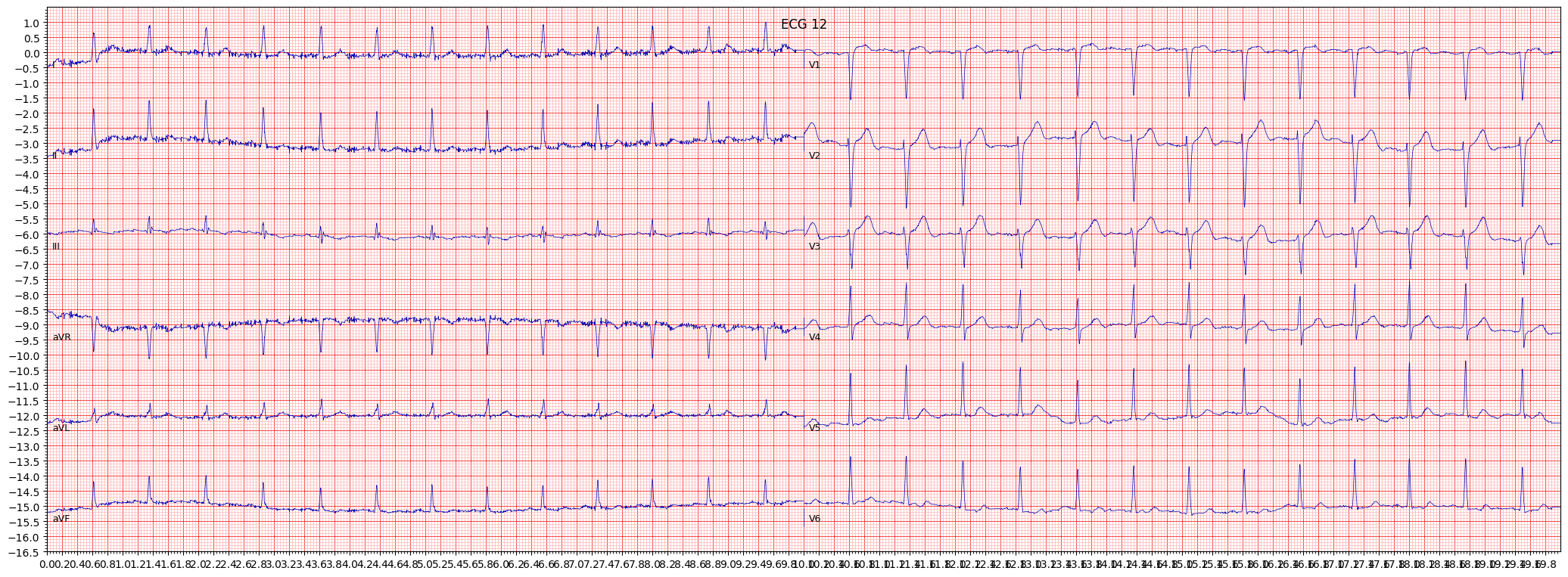 ECG example image