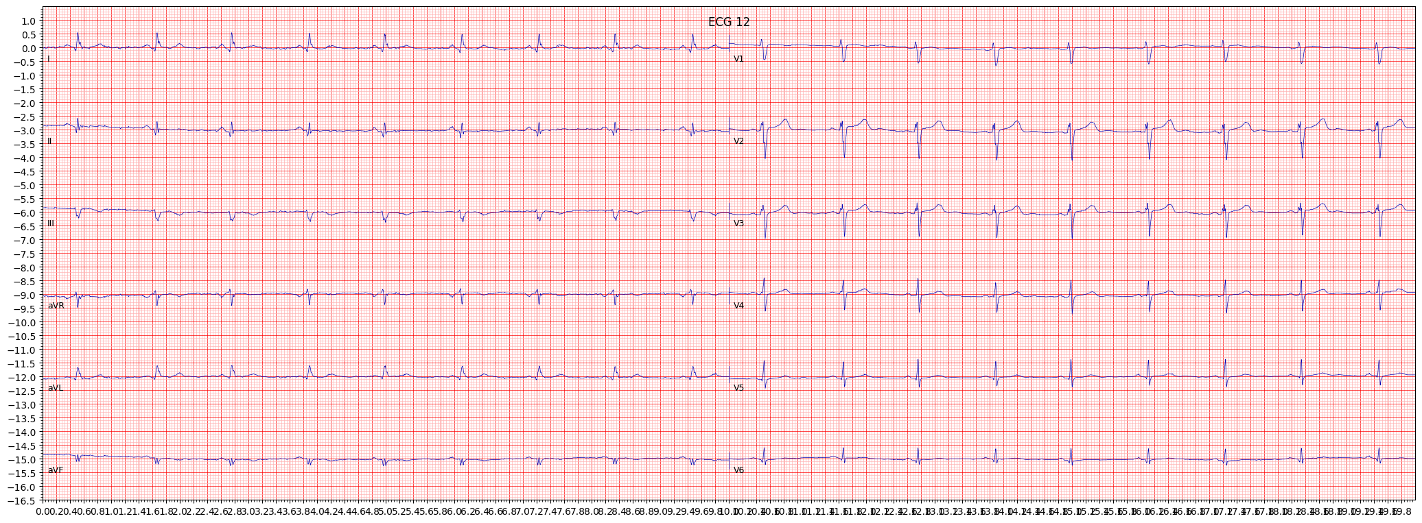 inferolateral myocardial infarction (ILMI) example 2118