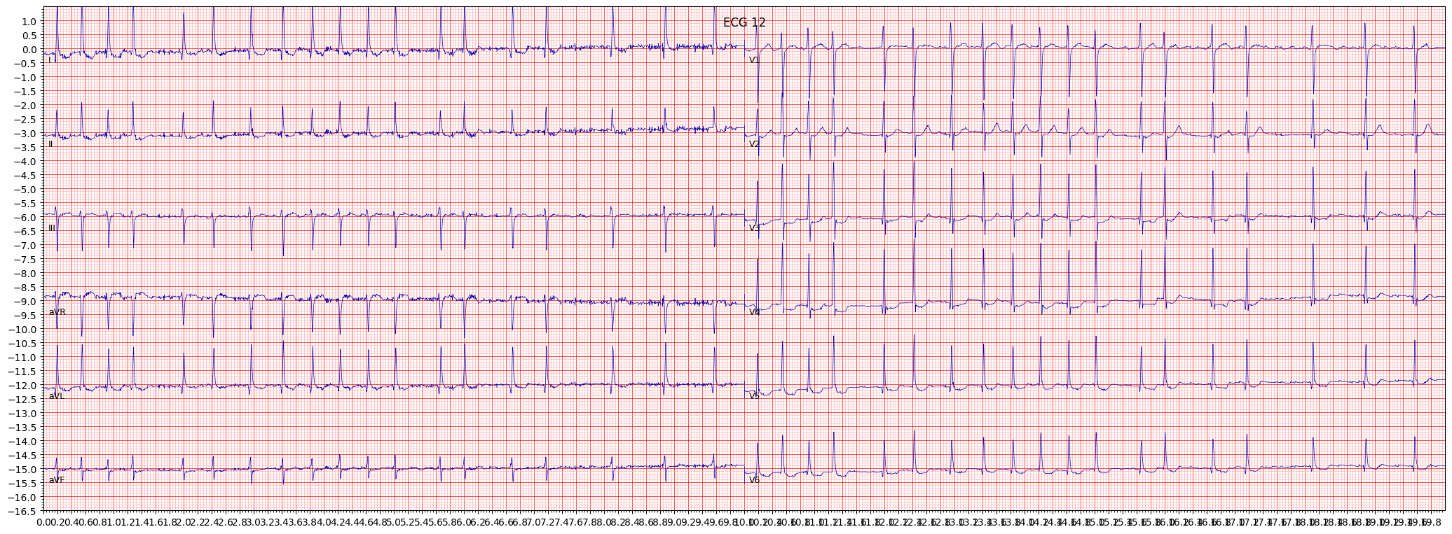 ECG example image