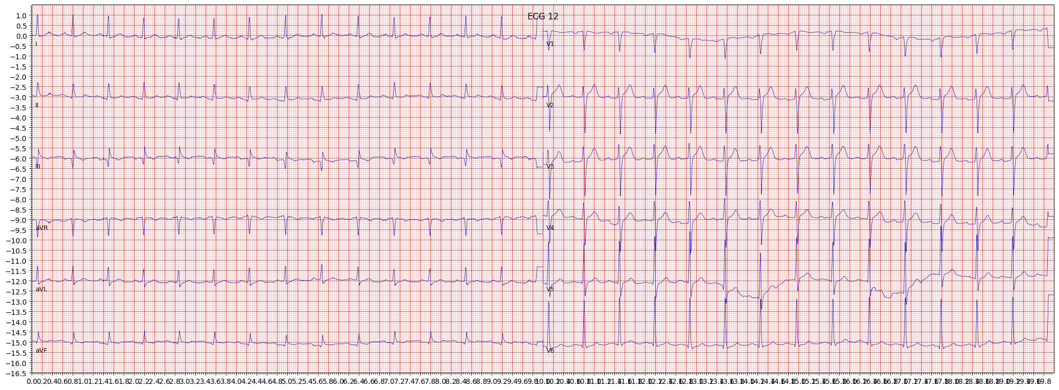inferior myocardial infarction (IMI) example 2134