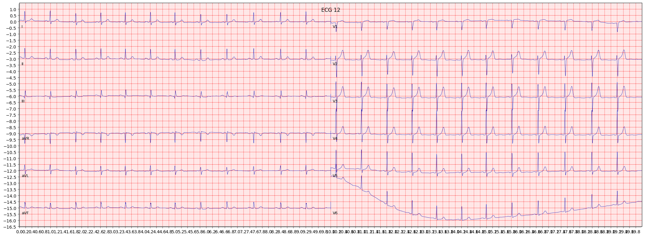 Normal ECG (NORM) example 214