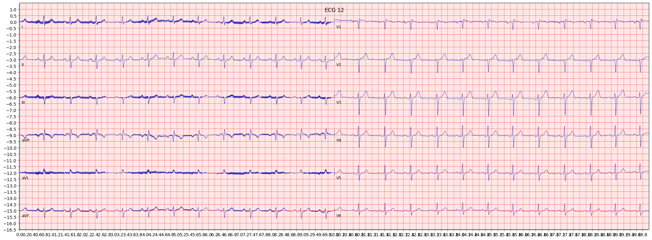 ECG example image