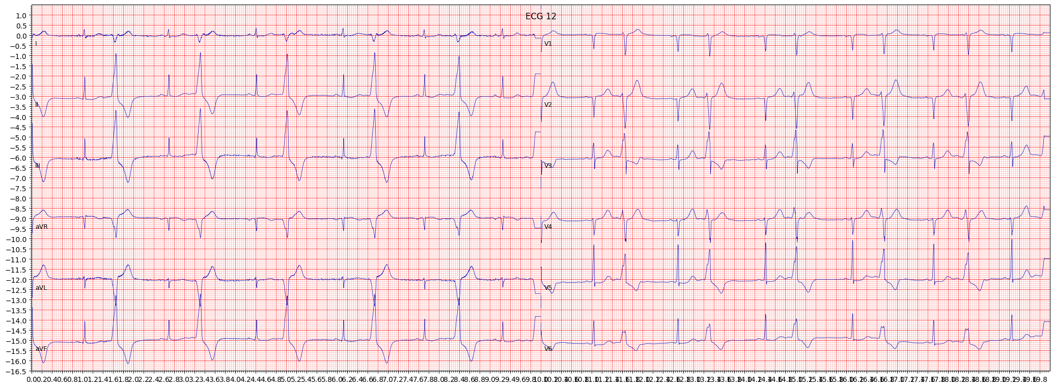 anteroseptal myocardial infarction (ASMI) example 2184