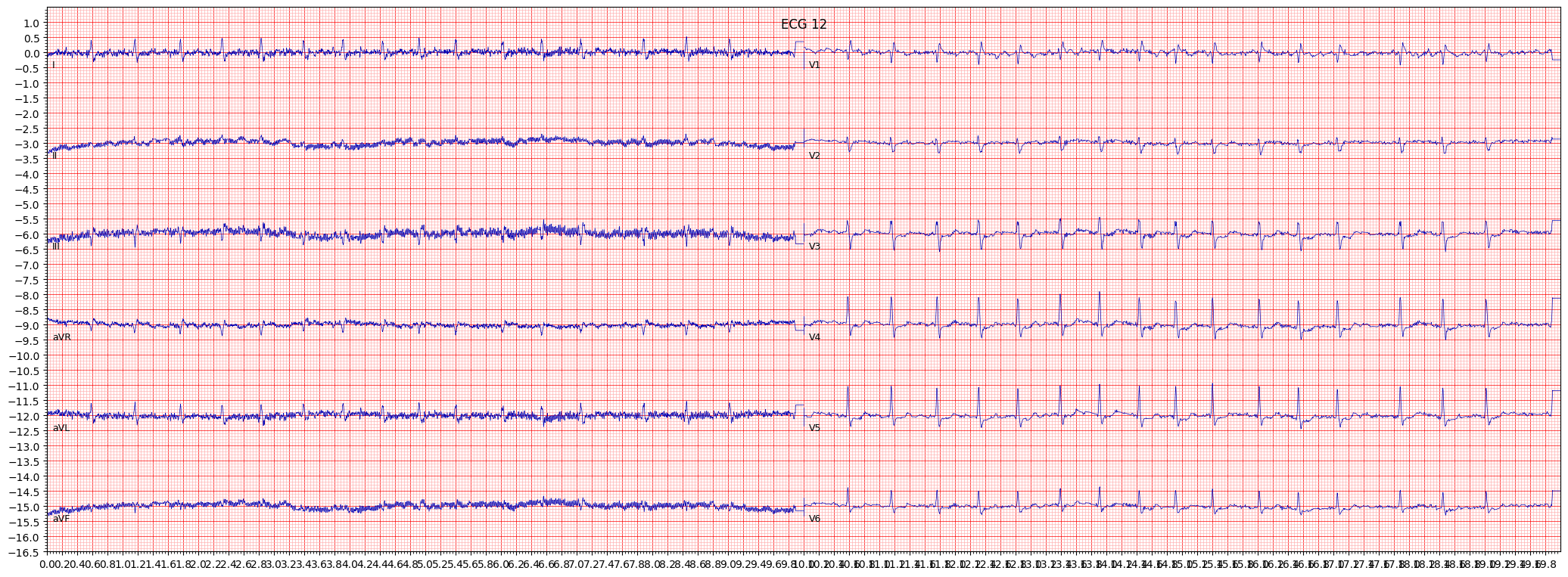 ECG example image