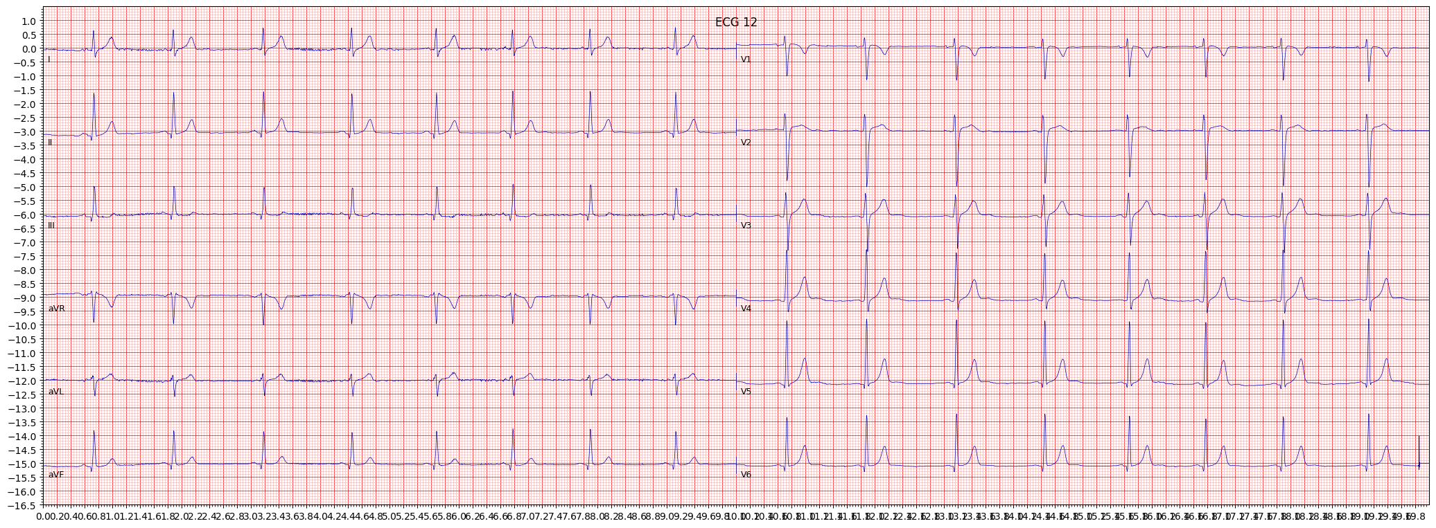 Normal ECG (NORM) example 231