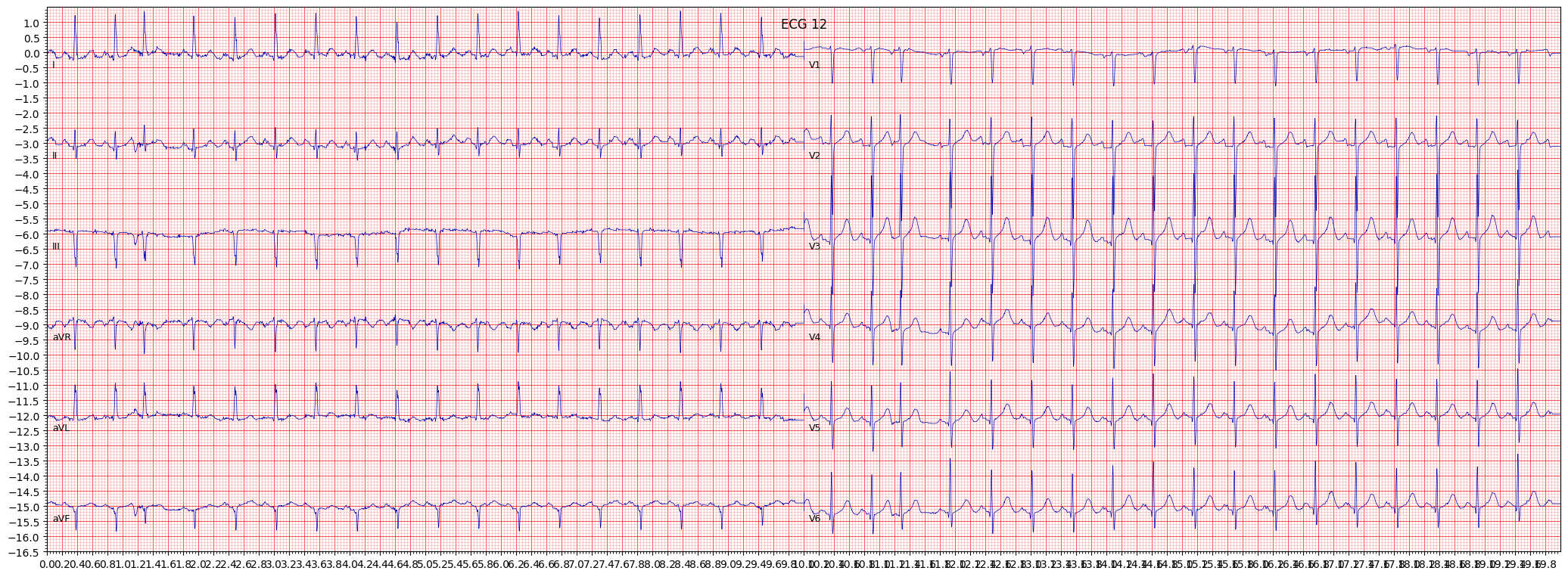 inferior myocardial infarction (IMI) example 2363