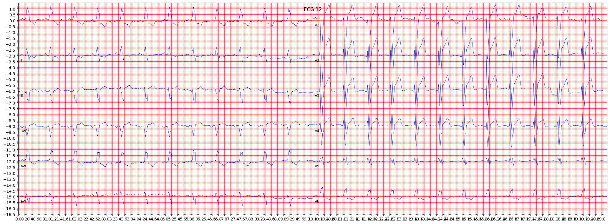 ECG example image