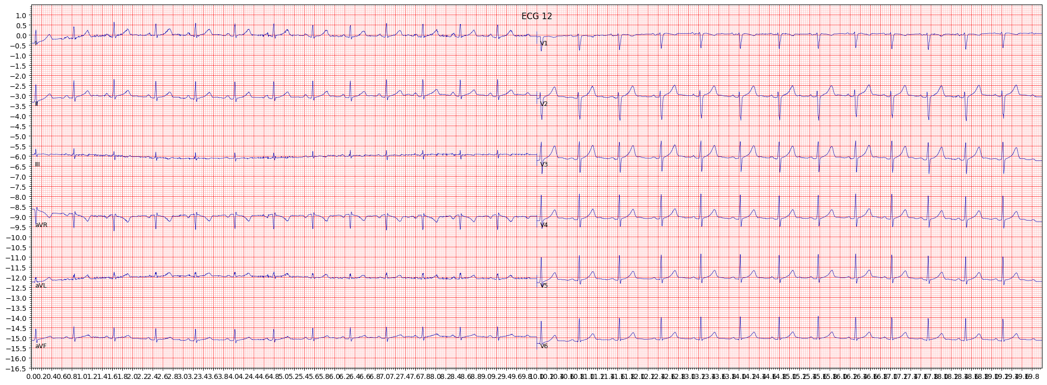Normal ECG (NORM) example 241