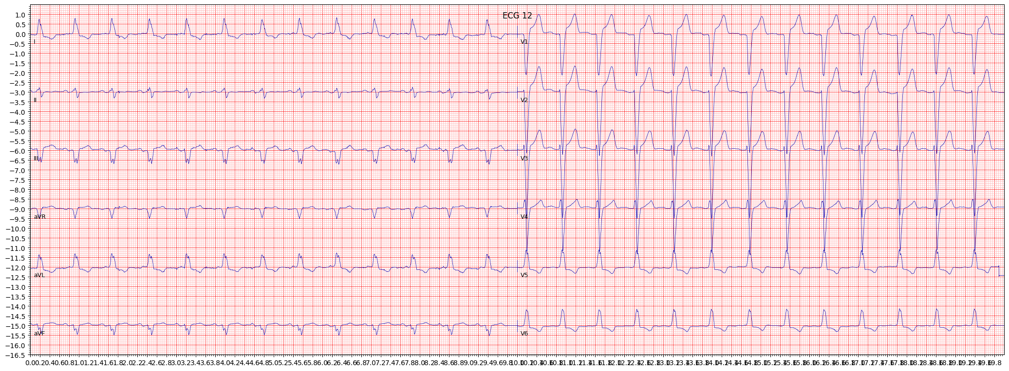 ECG example image