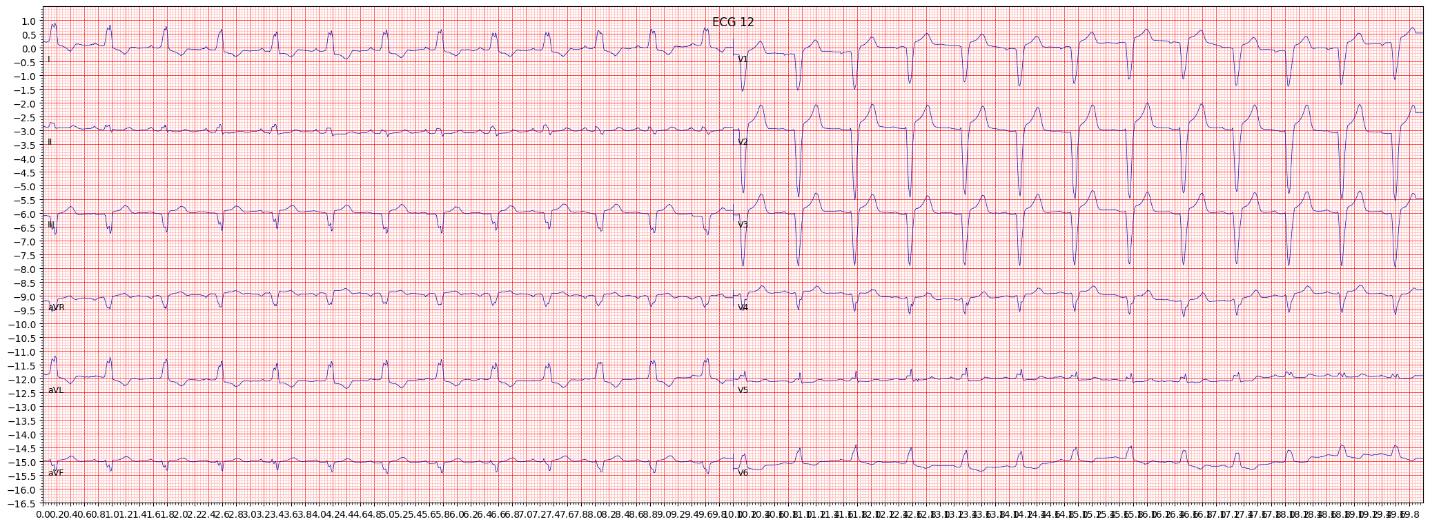 ECG example image