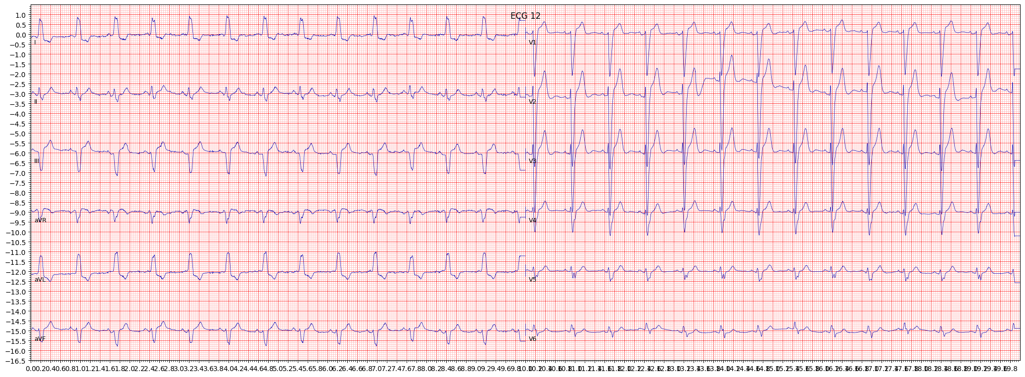 ECG example image