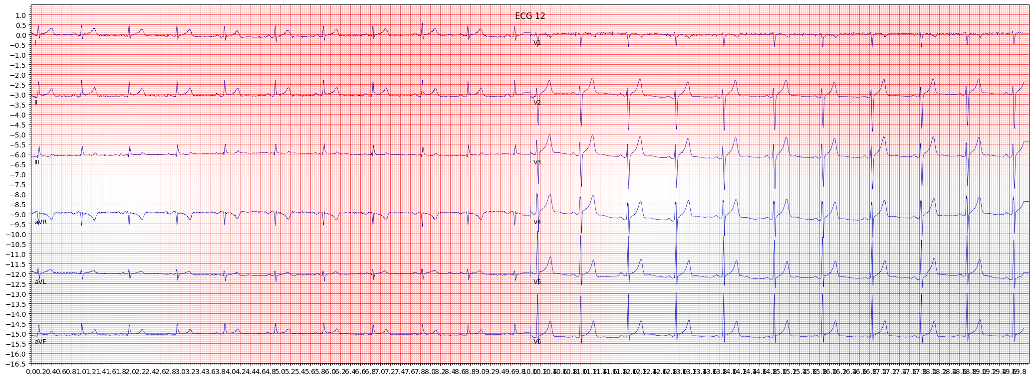 ECG example image