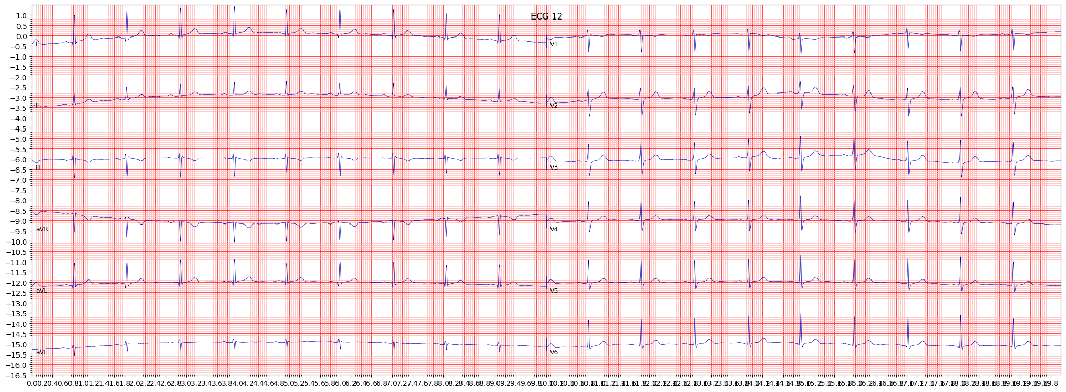 ECG example image