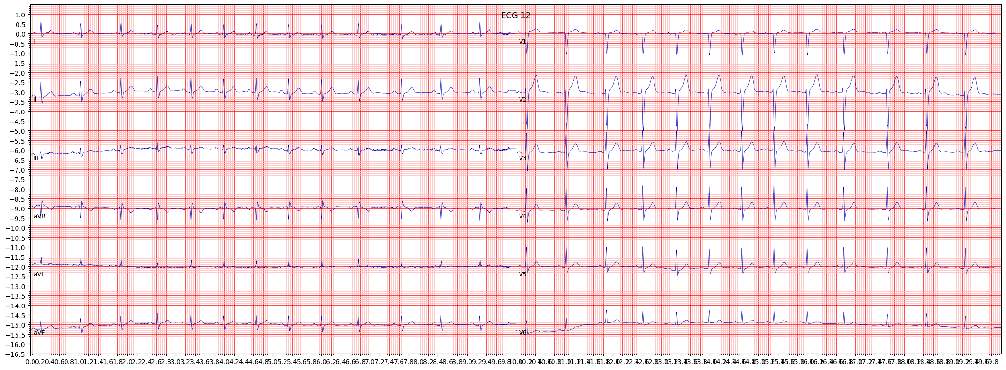 ECG example image
