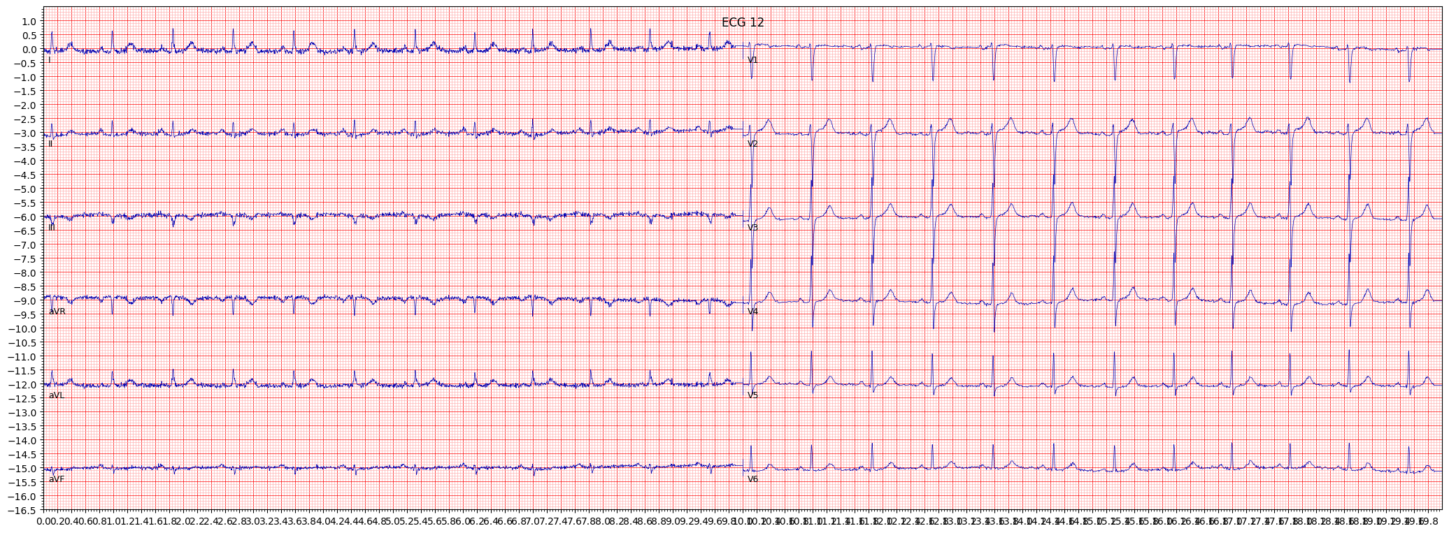 inferior myocardial infarction (IMI) example 290