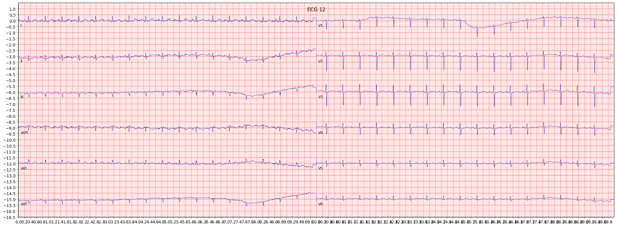 inferolateral myocardial infarction (ILMI) example 2902