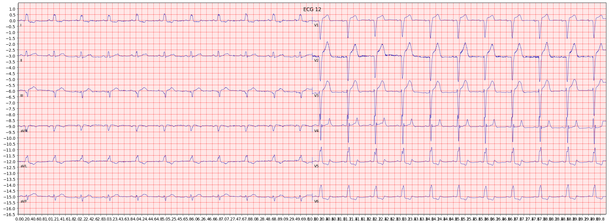 ECG example image