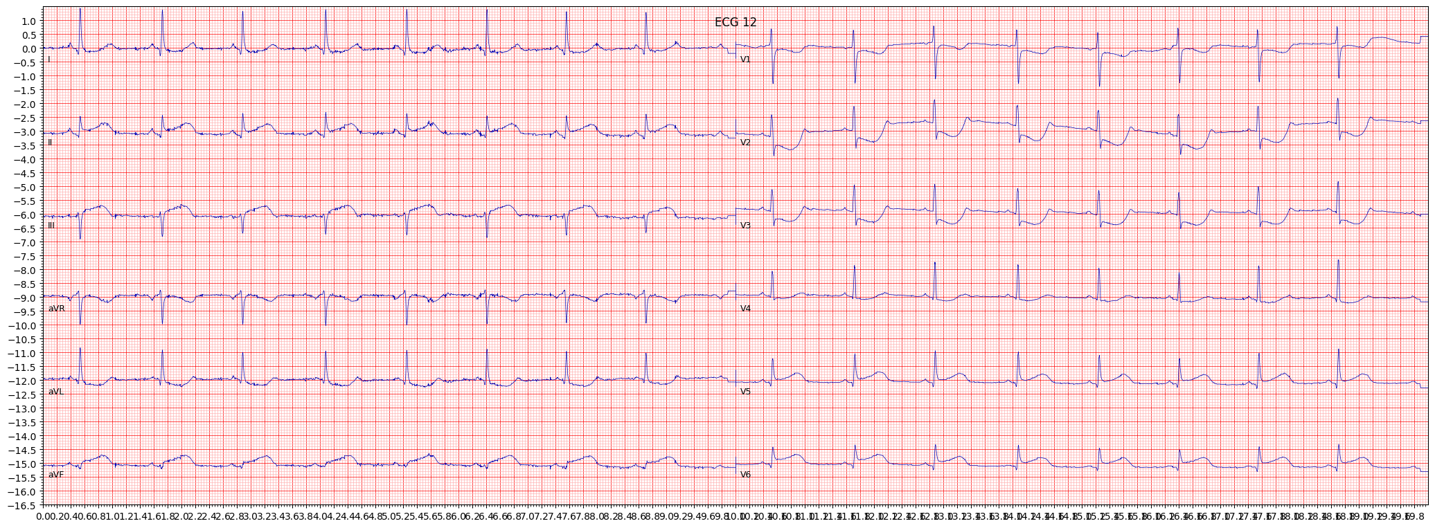 inferoposterolateral myocardial infarction (IPLMI) example 2993
