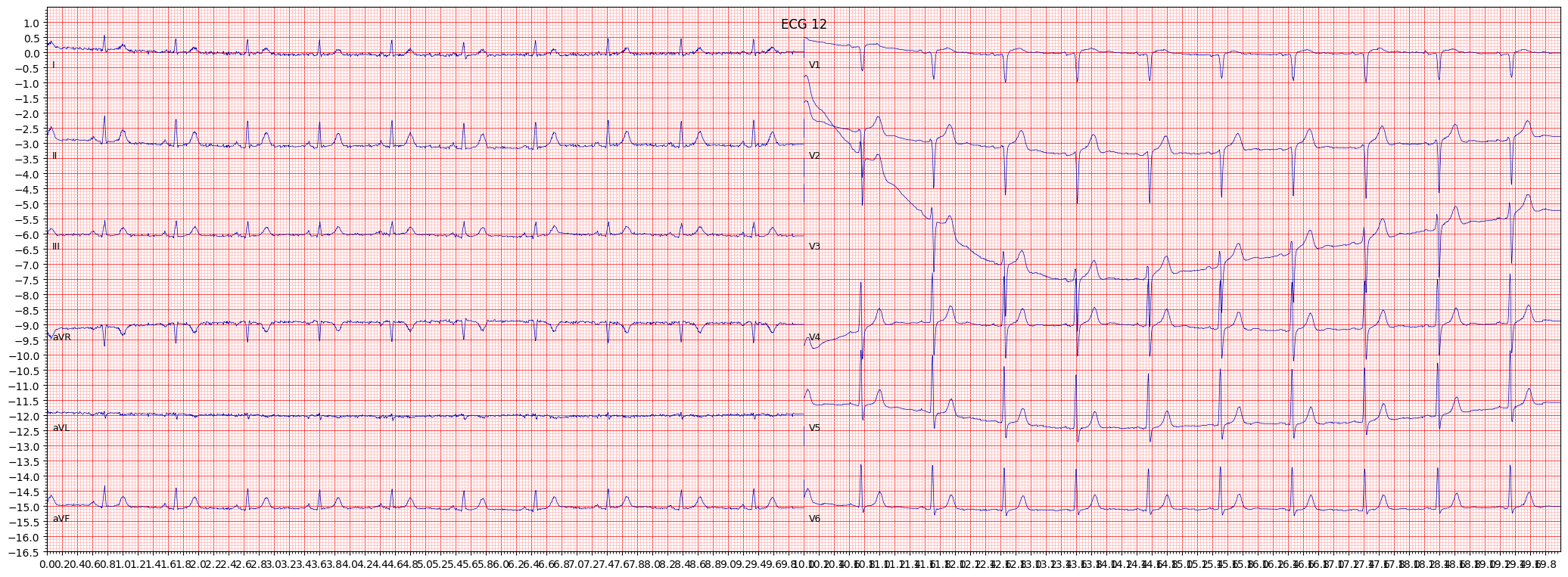 ECG example image
