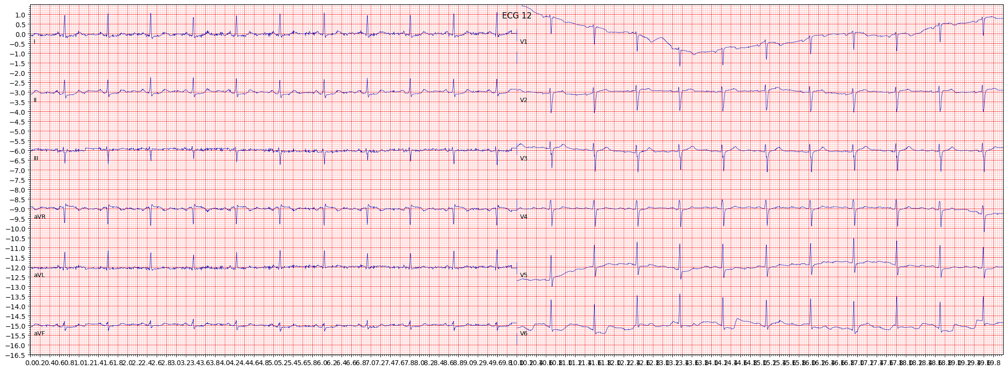 ECG example image