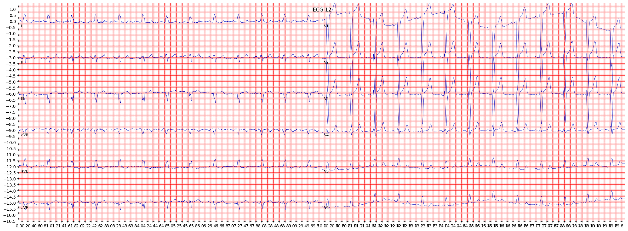 ECG example image