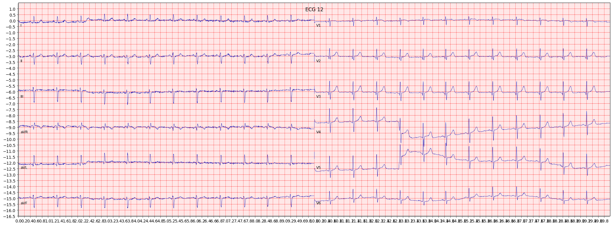 ECG example image