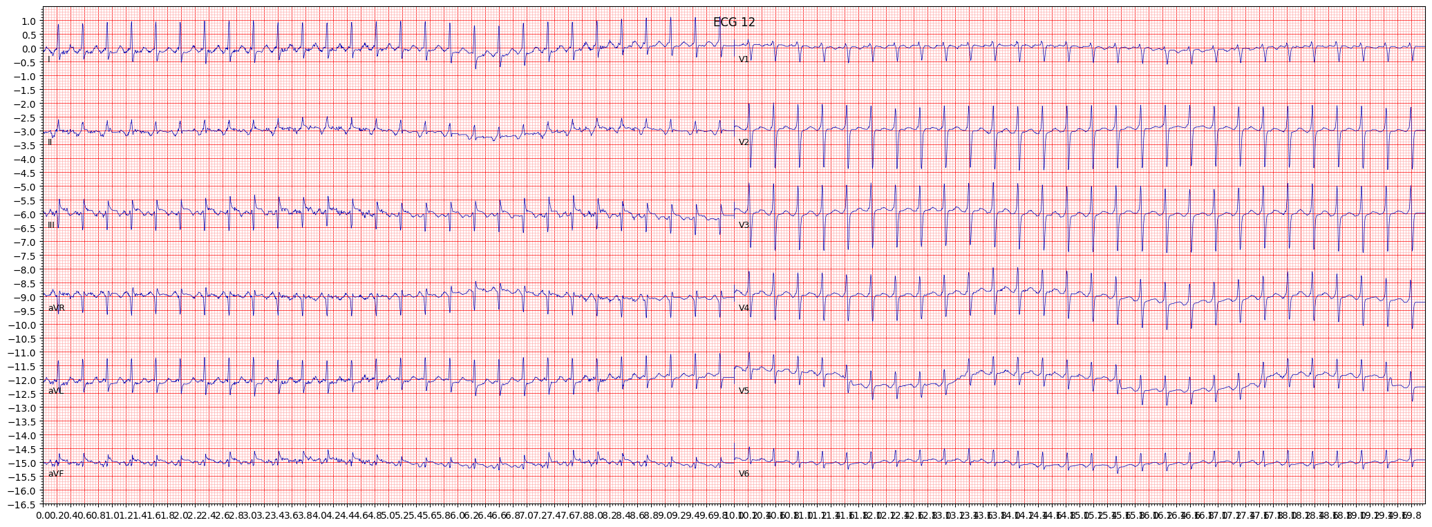 paroxysmal supraventricular tachycardia (PSVT) example 3134
