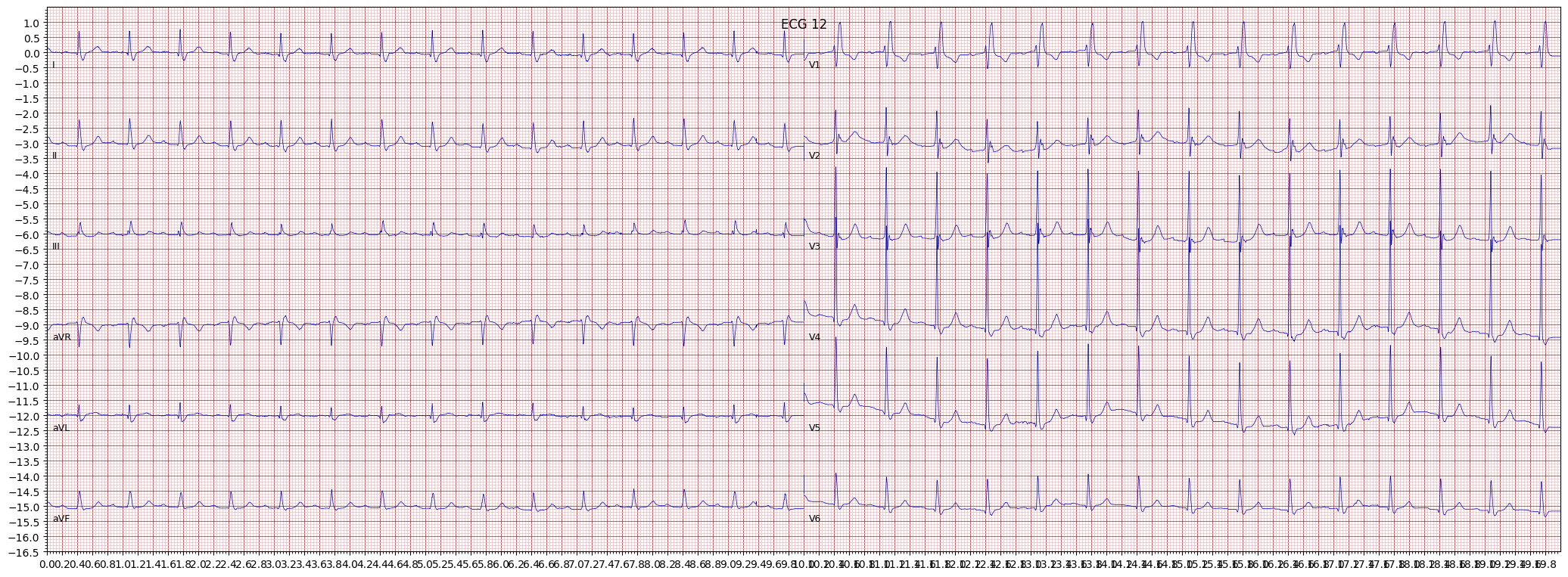 ECG example image