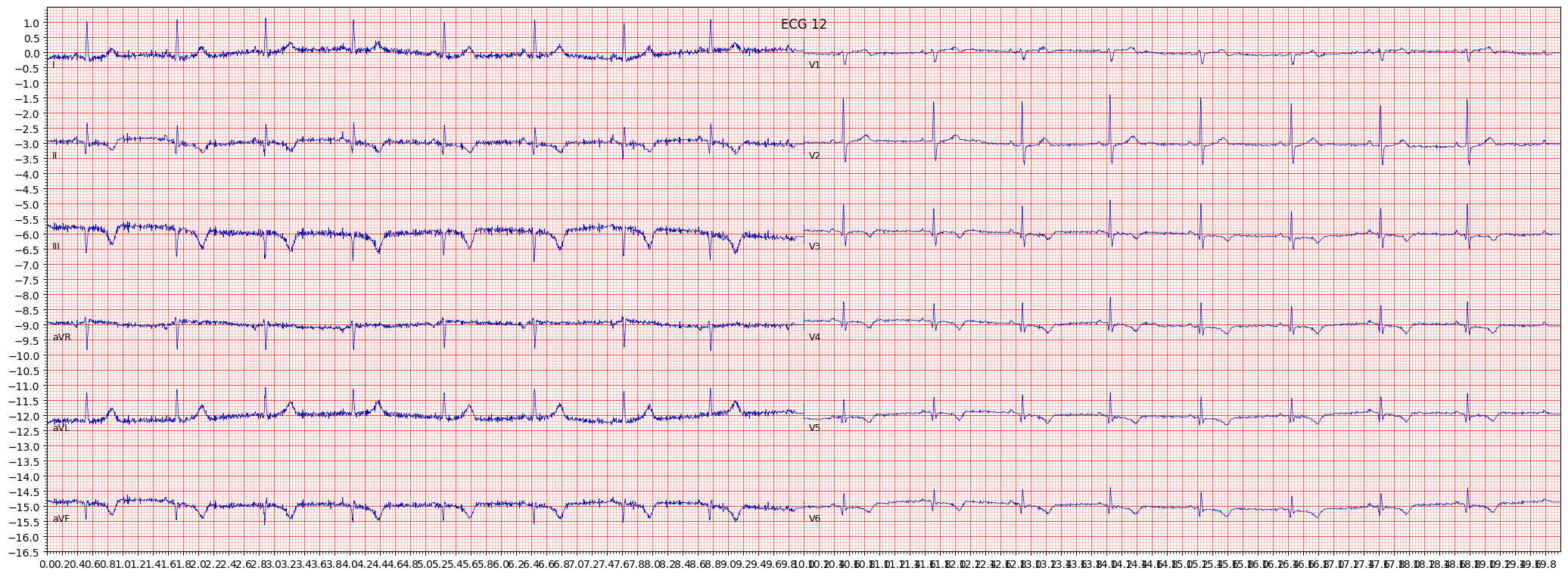 inferolateral myocardial infarction (ILMI) example 3219