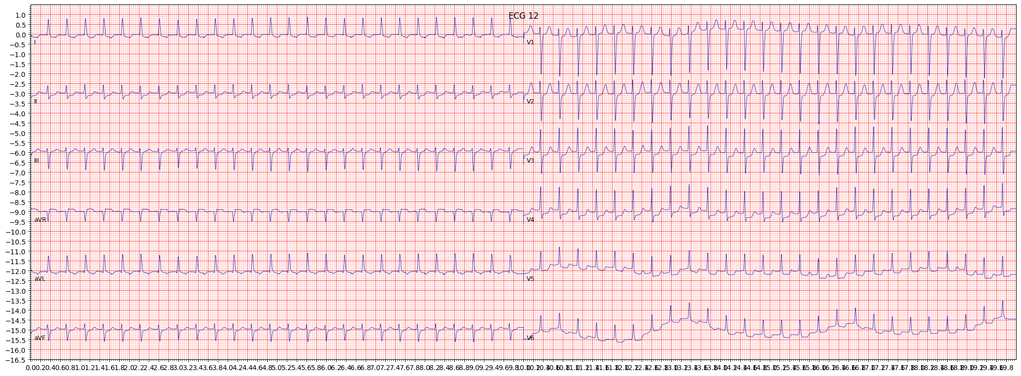 paroxysmal supraventricular tachycardia (PSVT) example 3267