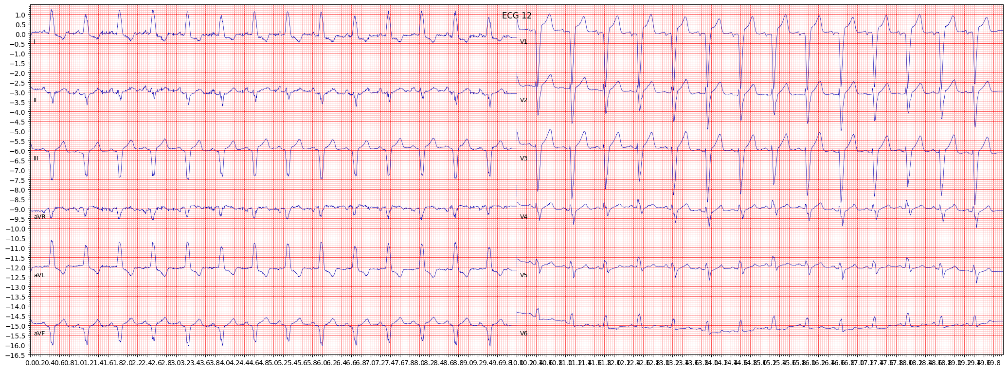 ECG example image