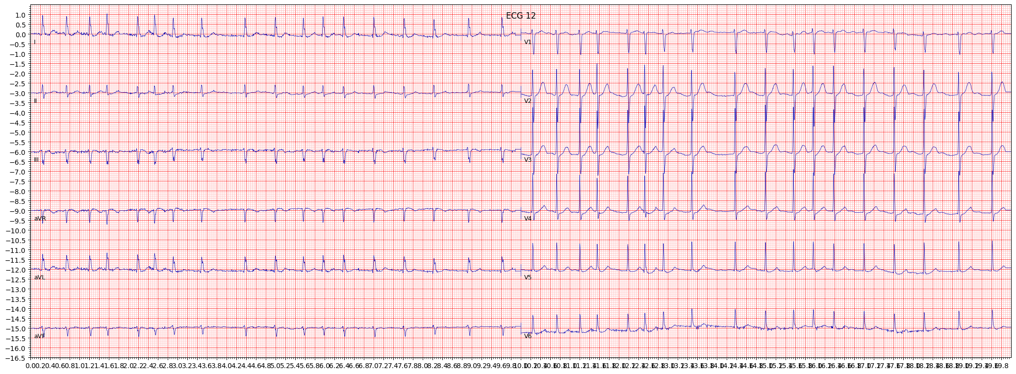 ECG example image