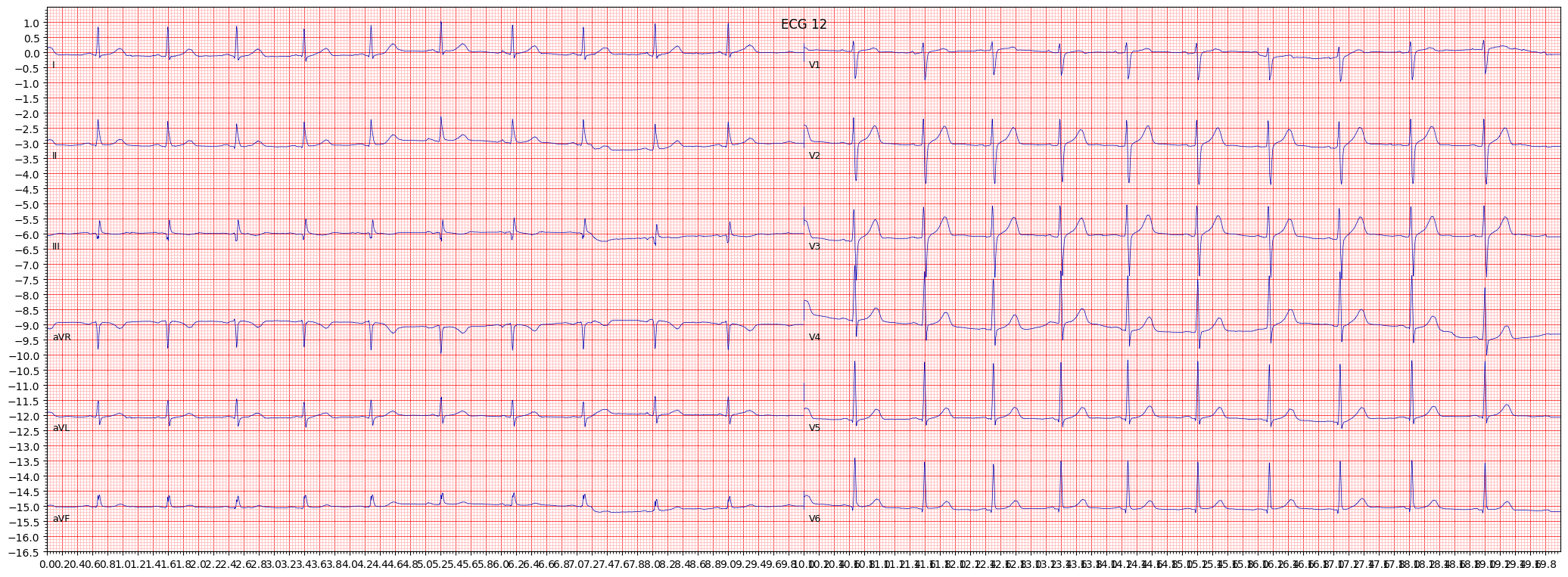 ECG example image