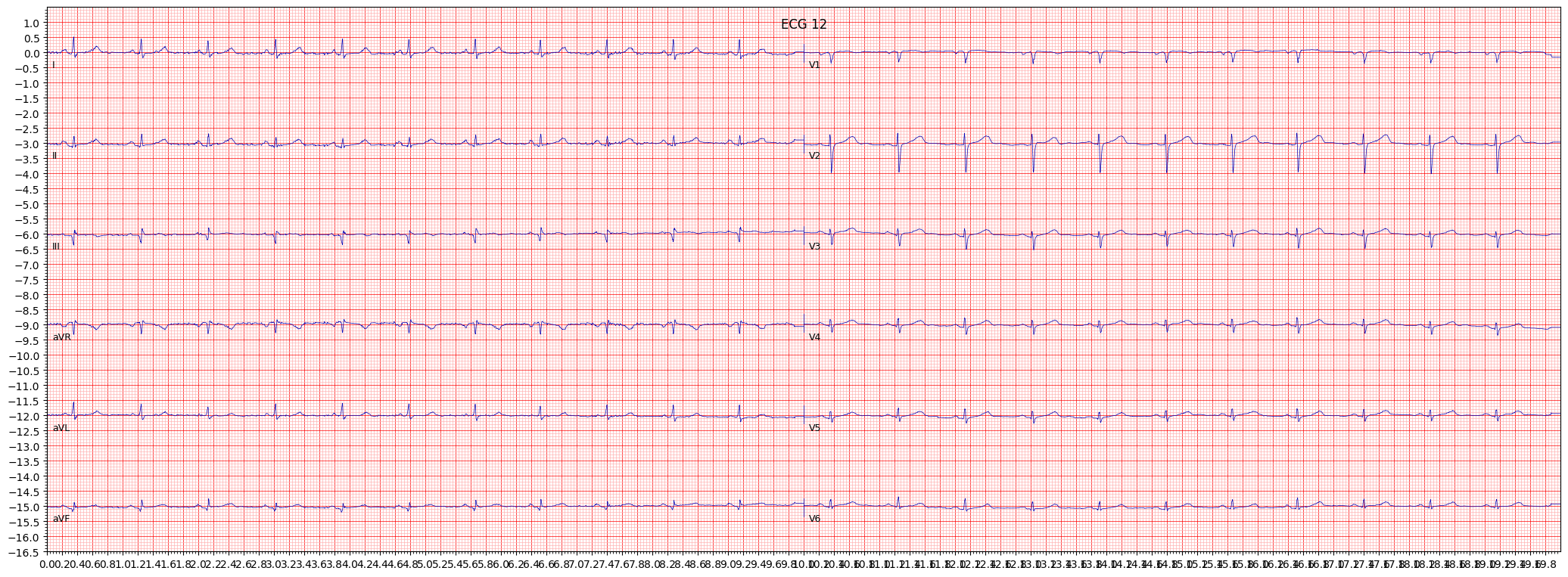 inferolateral myocardial infarction (ILMI) example 3376