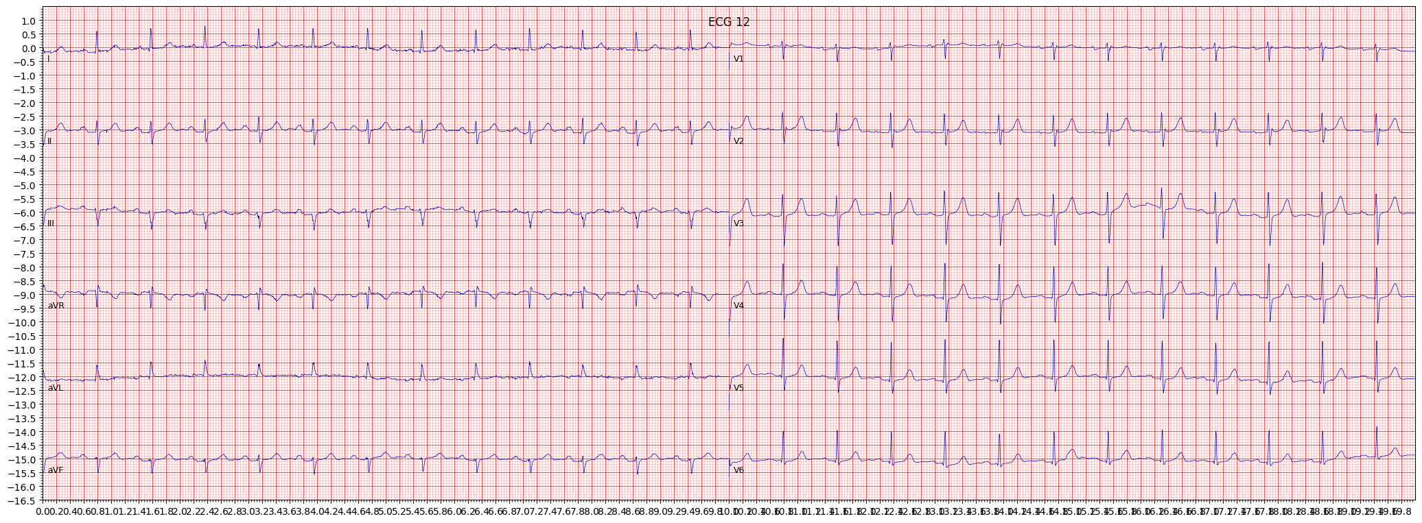 ECG example image