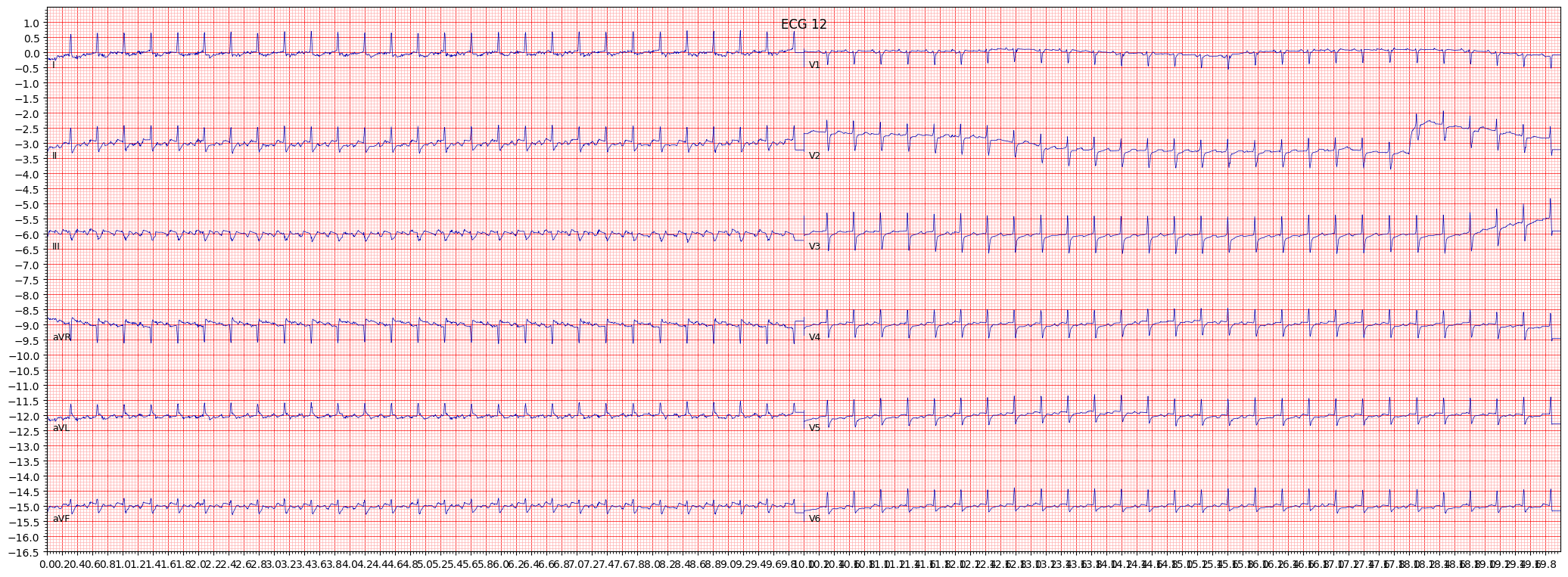paroxysmal supraventricular tachycardia (PSVT) example 3476
