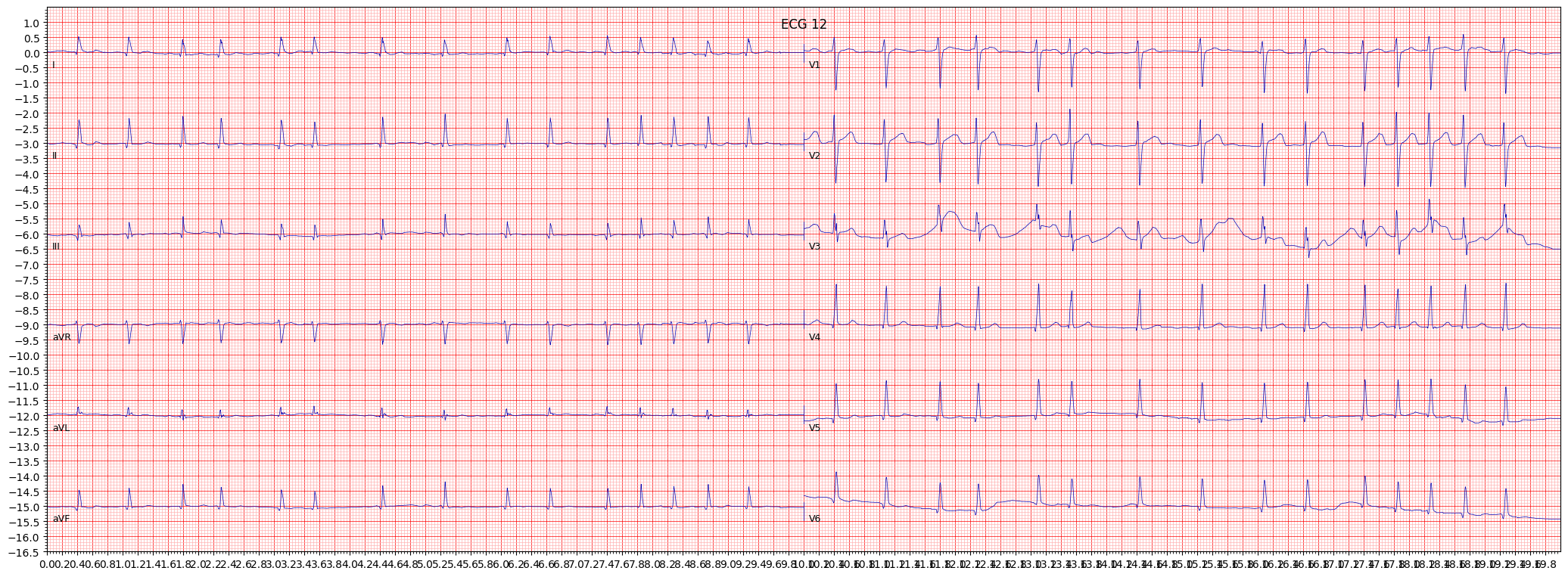 ECG example image