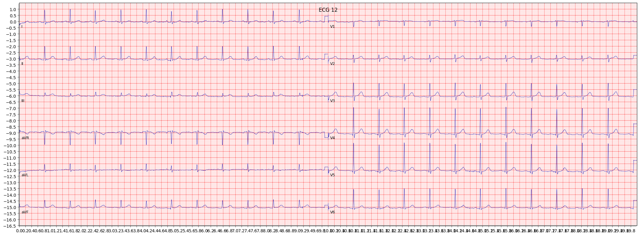 ECG example image