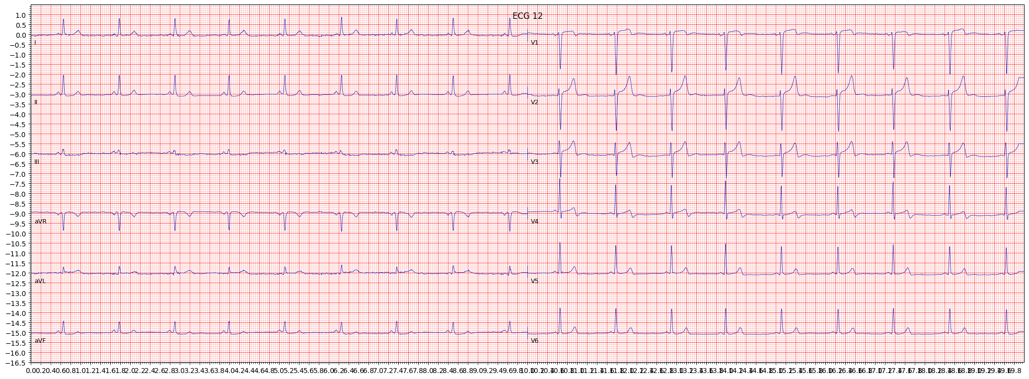 ECG example image