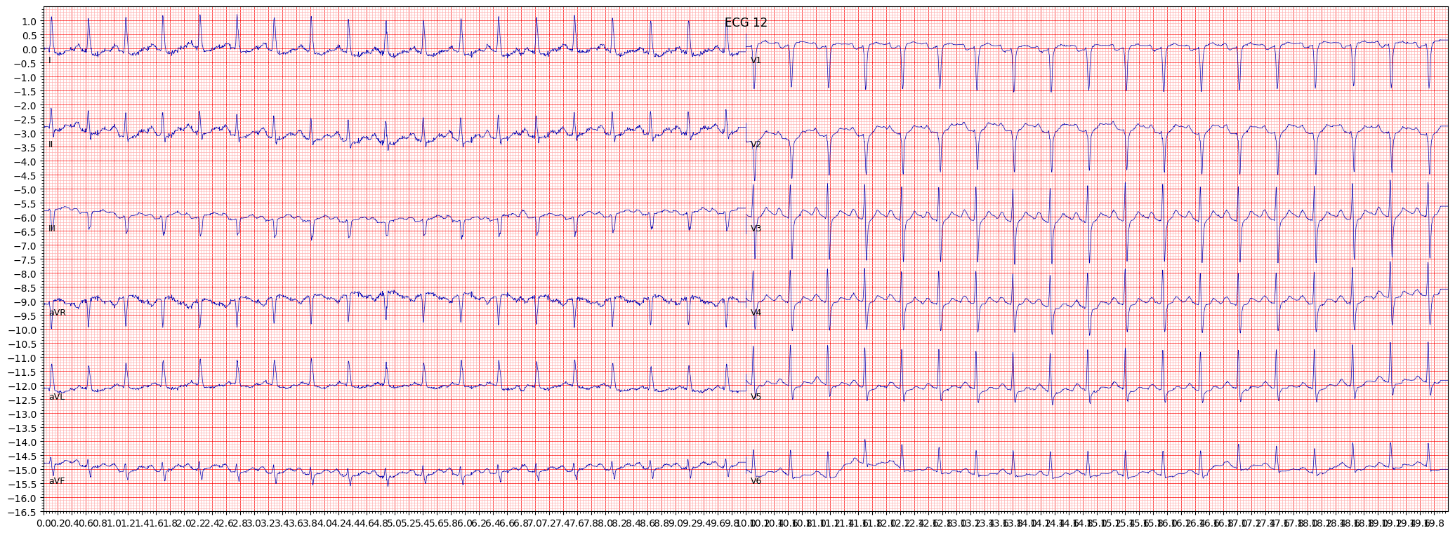 anterior myocardial infarction (AMI) example 3599