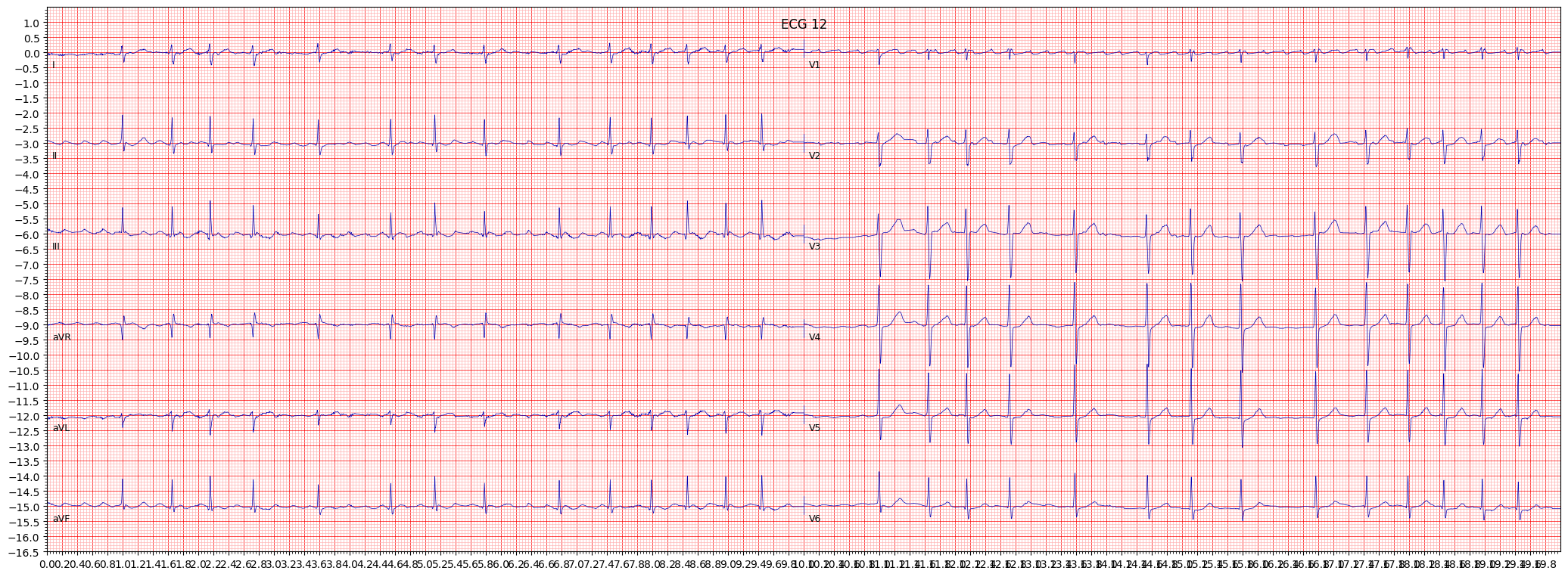 ECG example image