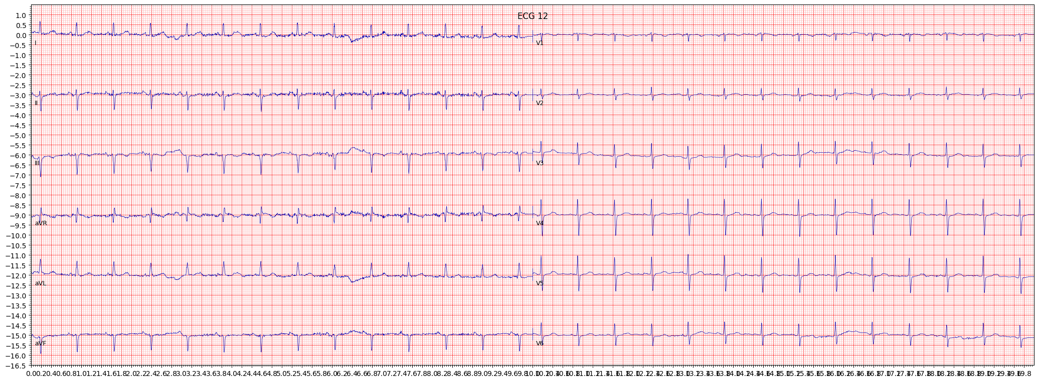 ECG example image
