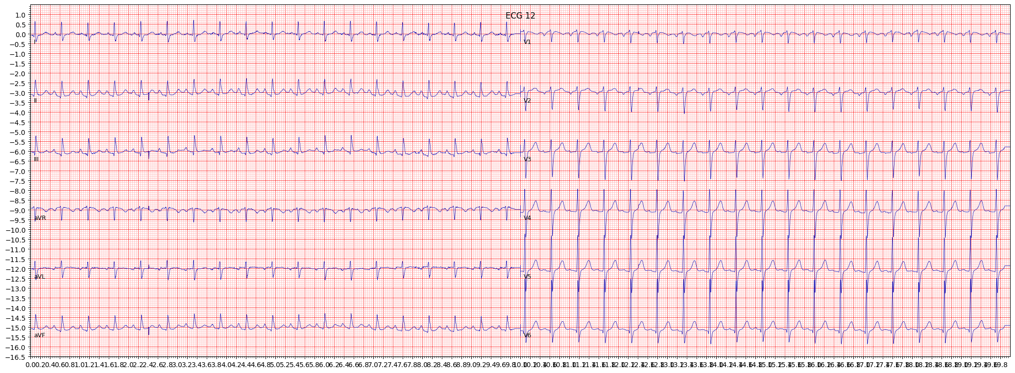 ECG example image