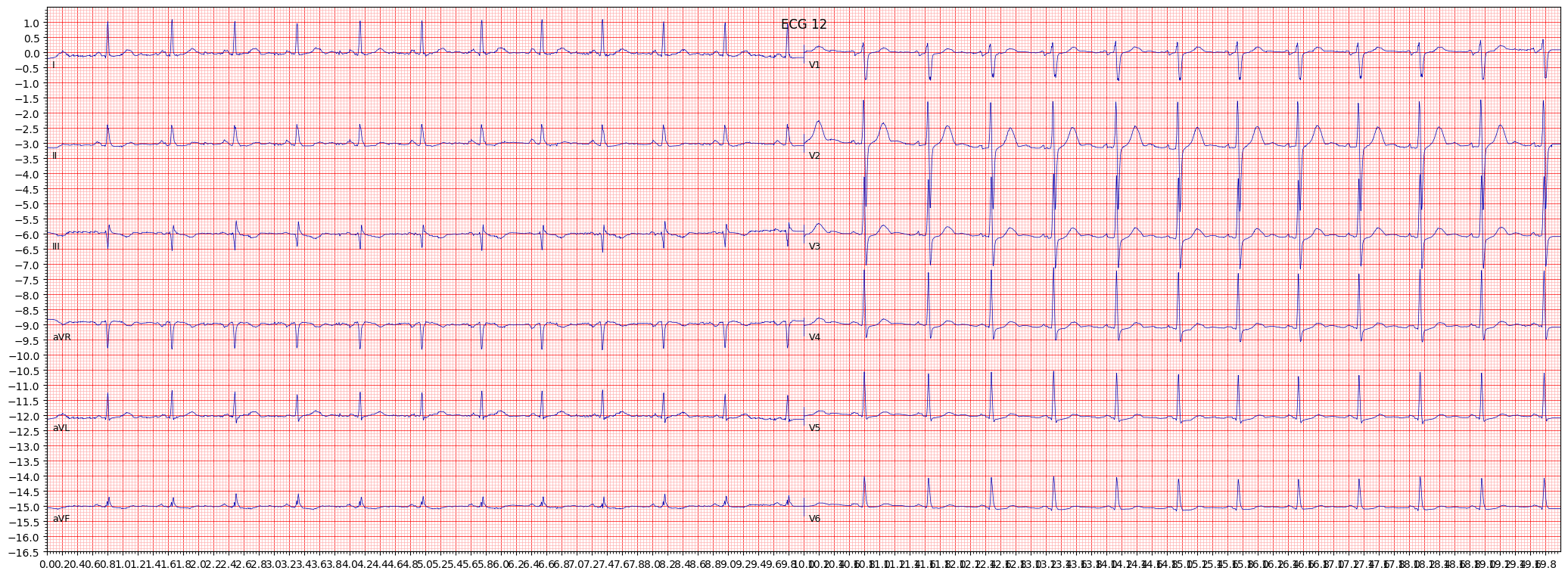 ECG example image