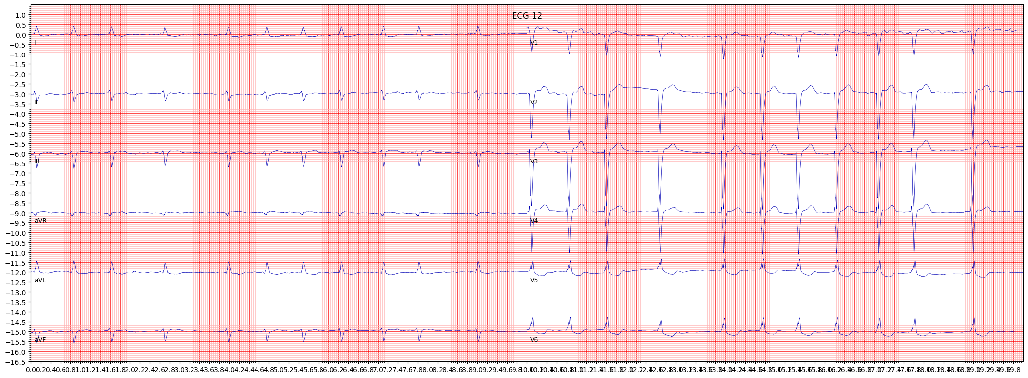 ECG example image