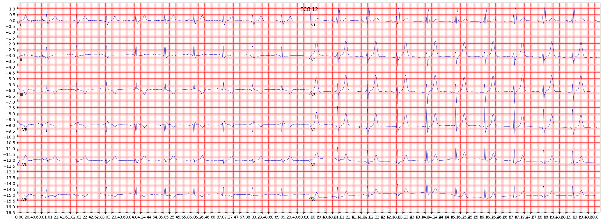 ECG example image