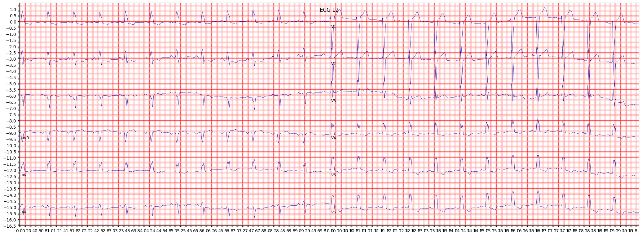 ECG example image