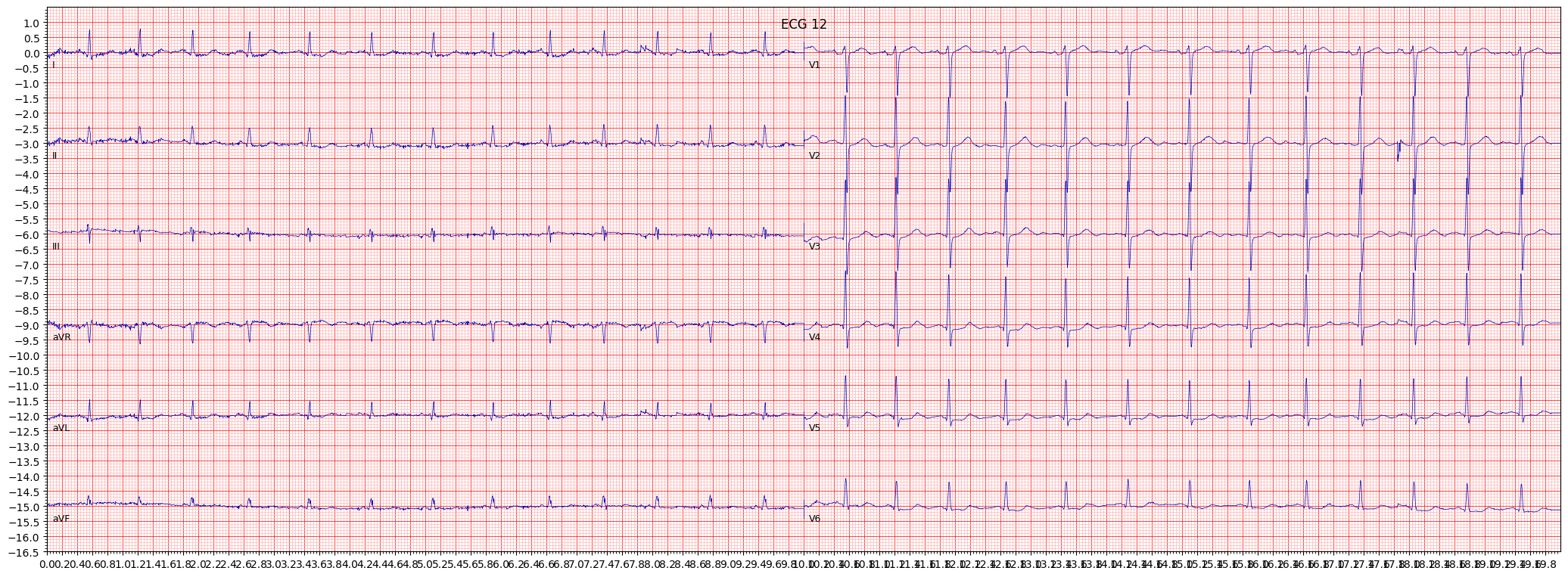 ECG example image