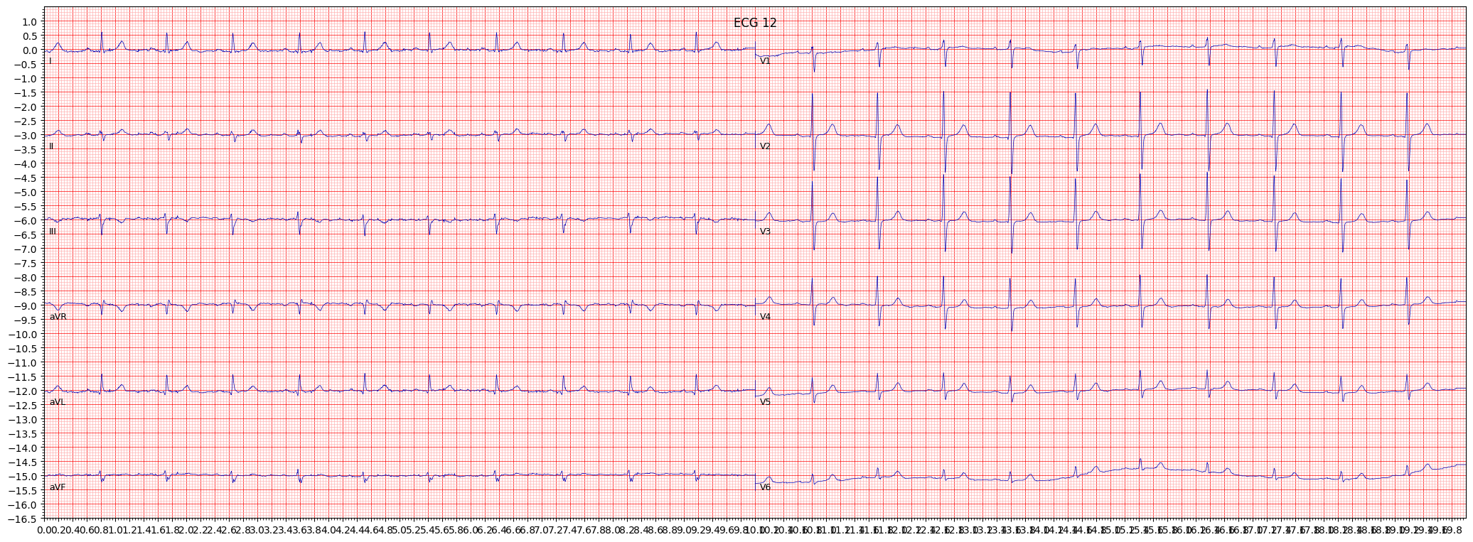 ECG example image